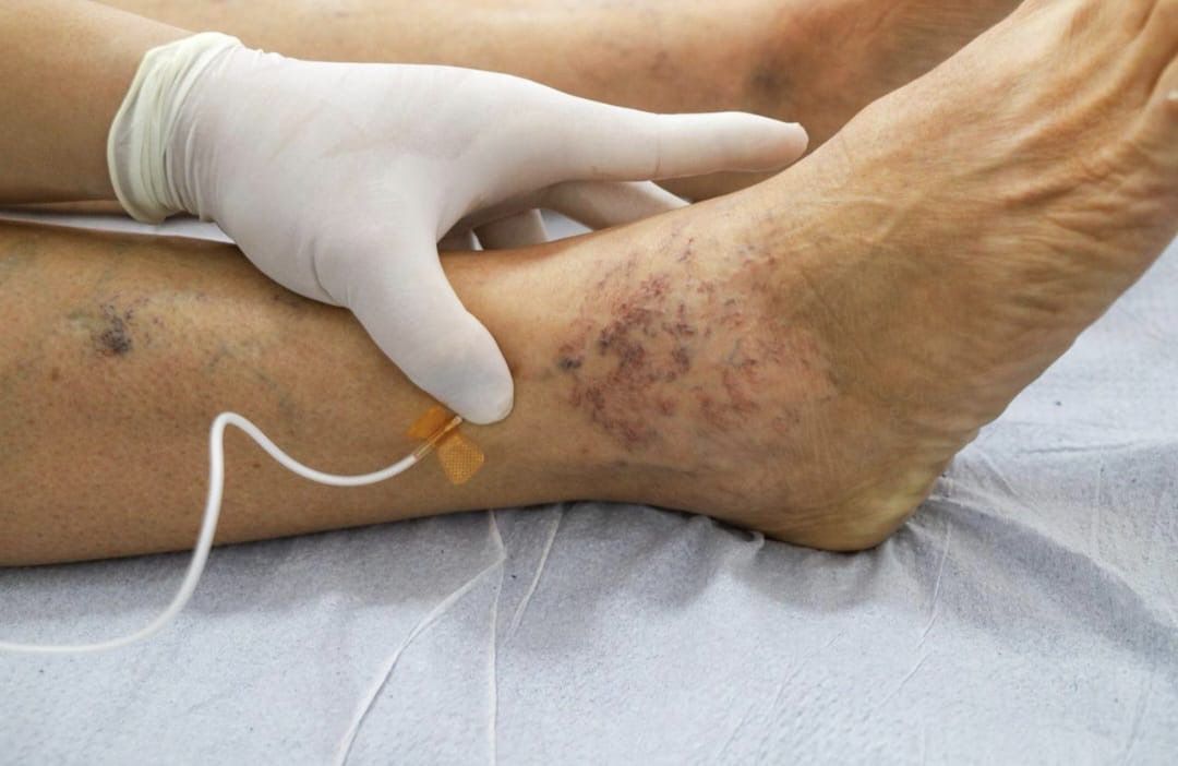 Programa para tratar varizes já beneficiou cerca de 2 mil pacientes no Hospital Municipal de Petrolina